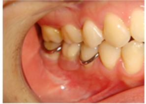 保険の部分入れ歯の特徴